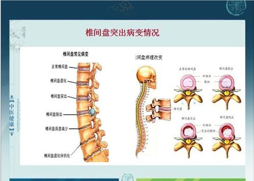 腰椎間盤突出 運(yùn)動_腰椎間盤突出運(yùn)動_突出腰椎盤間運(yùn)動能治好嗎