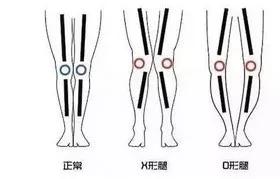 改善x型腿的瑜伽_瑜伽改善腿型動作_瑜伽腿型矯正