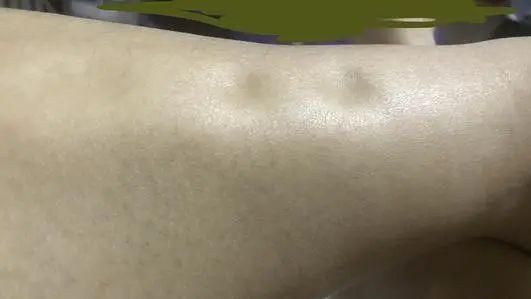 瘦腿操下載_瘦小腿不同類型針對性訓(xùn)練_判斷肌肉腿脂肪腿水腫腿